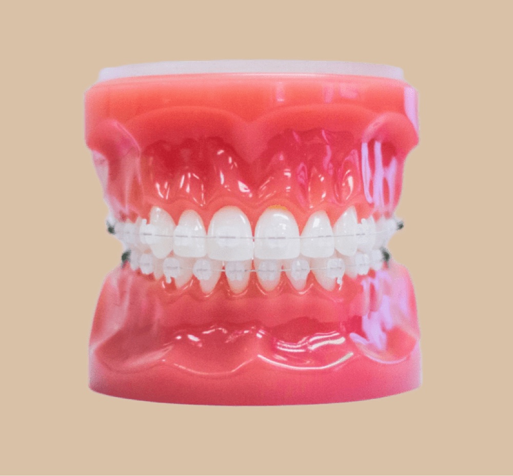 clear braces on plastic model