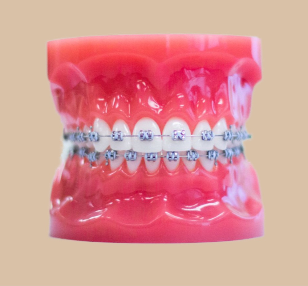 metal braces on plastic model